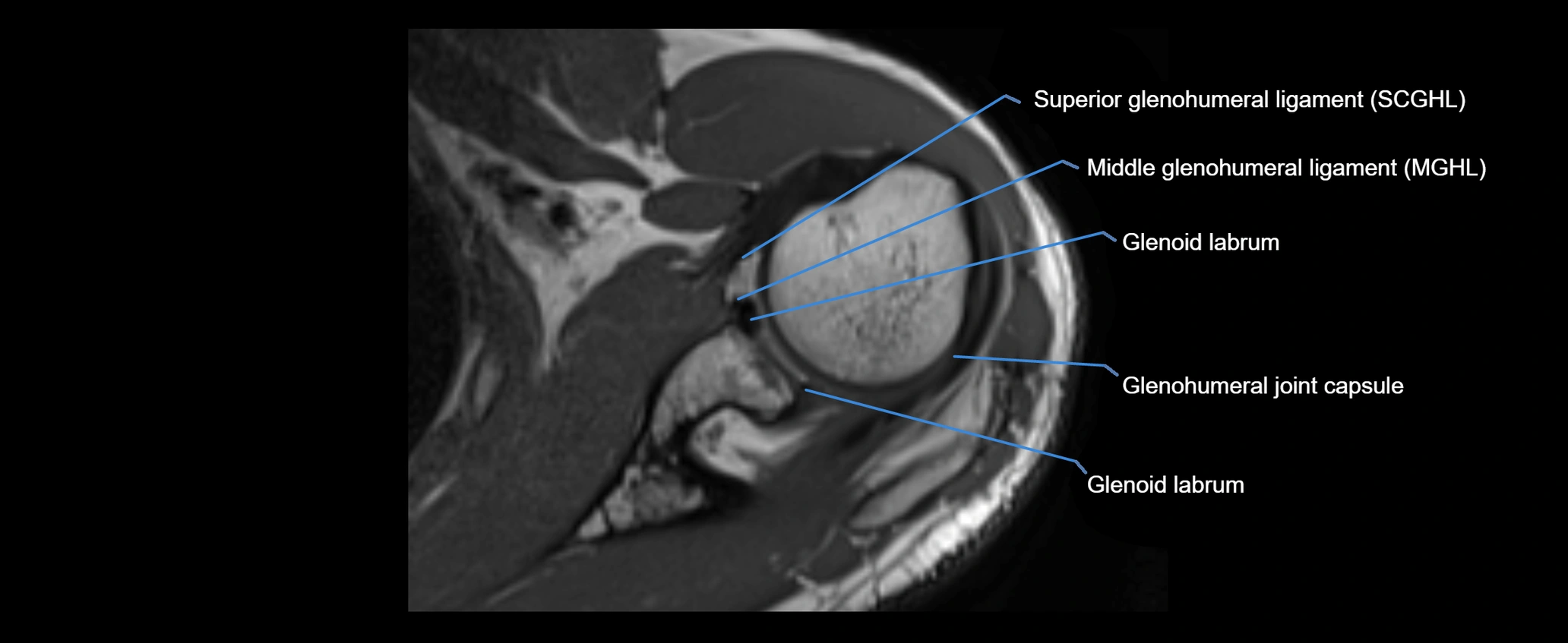 shoulder ligaments axial 3d 3t mri image-img-00005-00053.webp